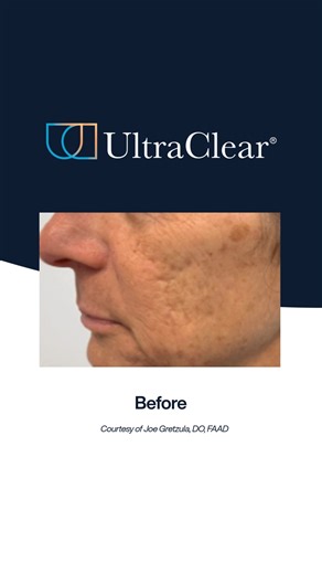 Progress you can see after just one treatment! Just one month after a single UltraClear®️ treatment, this patient experienced visible improvement in skin texture using multiple UltraClear modes and the appearance of scars using Laser-CoringTM, highlighting the versatility and effectiveness of advanced cold fiber laser technology. Courtesy of Joe Gretzula, DO, FAAD #UltraClearLaser #DrJoeGretzula #UltraClearBeforeandAfter | UltraClear Laser | Facebook