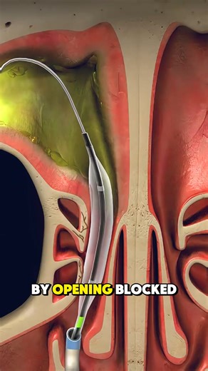 34K views · 207 reactions | How Balloon Sinuplasty Procedure Is Performed? (3D Animation). #how #ballon #sinuplasty #infection #treat #sinus #passage #anesthesia #gentle #pressure #gentlepressure #deflated #chronic #surgery #insert #tube #medical3danimation #3dmedicalanimation | Mix Dancing Events | Facebook