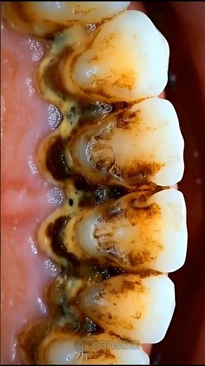 Extreme Dental Cleaning USA | Satisfying Tartar Removal #TeethCleaning #USAViral