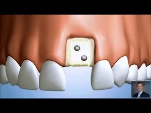 Block Graft with Dental Implant Placement