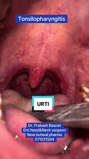 #tonsilopharingitis #foryou #viral #trending #trending #fyp #fypシ゚viral #entdoctorbutwal #ent #foryoupage