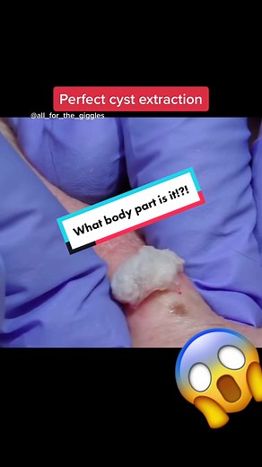 Cyst extraction! #whiteheadremoval #cystexplosion #cystpopping #whiteheadextraction #whiteheadremovals #blackheadpimple #blackheadsremoval