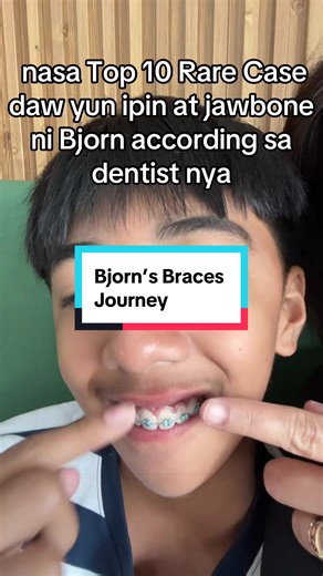 Bjorn's Orthodontic Journey: Understanding His Treatment