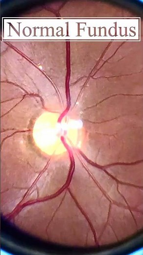Normal fundus | Normal Retina | Smartphone Fundus Videography | Fundus Photography | Short Video 200