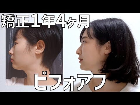 ワイヤー矯正1年4ヶ月。歯と顔のビフォアフひたすら垂れ流す動画