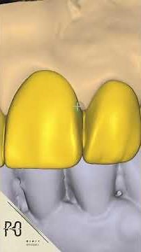 FP1 in process #exocad #anatomy #dentalcaddesign #cadcam #dental #odontologia
