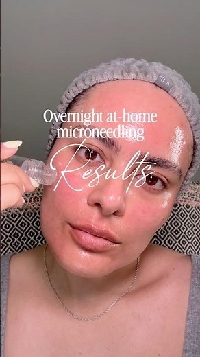 Esthetician tries the #seranova at home #microneedling kit #skincare #antiaging #skincareresults