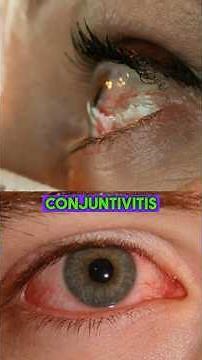 Conjunctivitis Treatment #conjunctivitis #treatment #antibiotics #bacteria #eyes #minsa