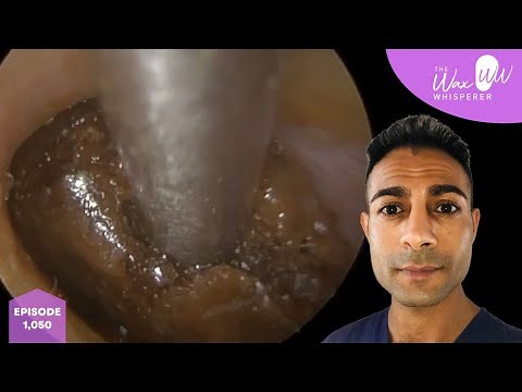 1,050 - Monumental Ear Wax Removal