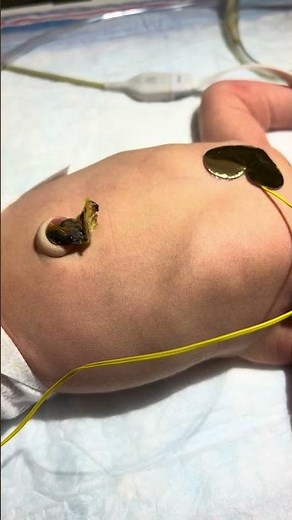 Newborn Retractions Video Clip