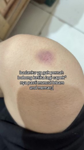 Penyebab Badan Mengalami Memar Saat Capek