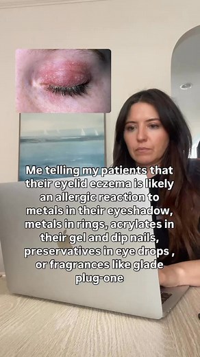 Did you know these were common eyelid dermatitis triggers?If you suddenly develop eyelid eczema, suspect an allergic skin reaction. Eyelid skin is very thin and more prone to allergies.There are also other causes of eyelid dermatitis such as eczema or seborrheic dermatitis so if you can't identify a trigger, it's best to see a derm for evaluation#dermatology #dermatologist #eyelideczema #eczema | Dr. Jessica Burgy