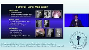 Revision Anterior Cruciate Ligament Reconstruction