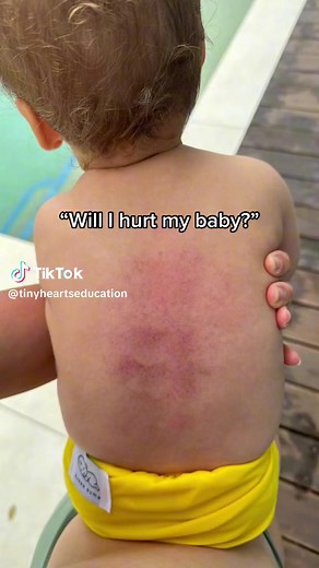 10M views · 62K reactions | Bruises can heal, a child without oxygen...