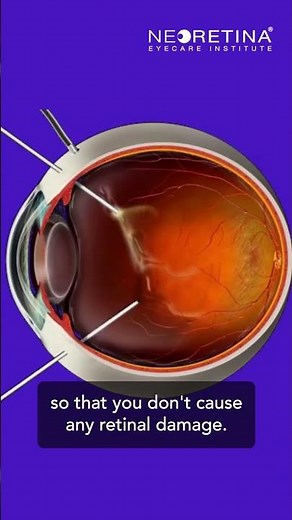 Ever wondered what happens during a vitrectomy?
