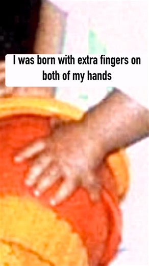 Tools and Testimony on Instagram: "I use to have extra fingers on both my hands. Watch and listen to the story of what they’ve been up to since having them removed. #extrafingers #shortfingers #fingers #finger #dwarfism #dwarf #littlepeople #littleperson #lpa #dwarfismawareness #funnyvideos #funny #fyp #christian #findinggod #fypシ #fypage #viral #viralvideo #viralreels #reel #reelitfeelit"