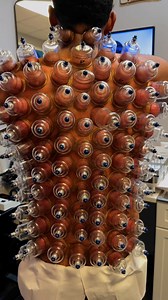 17K views · 61 reactions |  What is Cupping Therapy?Cupping therapy...