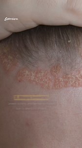 Common scalp problems like seborrheic dermatitis, scalp psoriasis, atopic dermatitis, folliculitis, and scalp eczema are not only uncomfortable, they can also affect your confidence. But, fret not! Svenson has got you covered! Our Bio Scalp treatment is designed to tackle these issues head-on. Plus, our expert trichologists provide personalized treatment plans tailored to your hair and scalp needs, ensuring you get the best care possible. Say goodbye to scalp problems! DM us! #FightForEveryStran