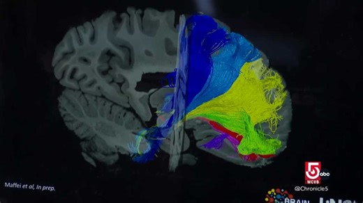 Mapping the brain: How MRI, microscopes and AI are revealing the brain’s hidden networks
