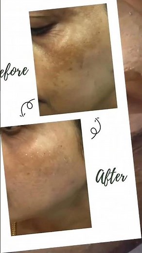 Cosmelan Peel Treatment