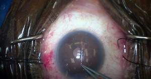 KDB Glide: Excisional Goniotomy - Eyetube