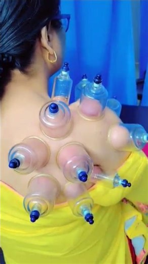 shoulder pain #cupping