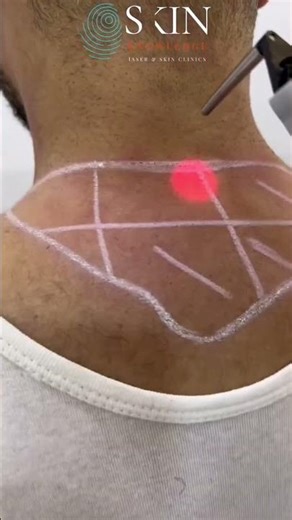 Men's Back Hair Laser Hair Removal