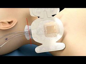 3M™ PICC/CVC Securement Dressing Application Video