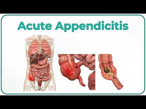 Acute appendicitis USMLE Step 1 : Etiology, Pathophysiology, Clinical Features, Diagnosis, Treatment