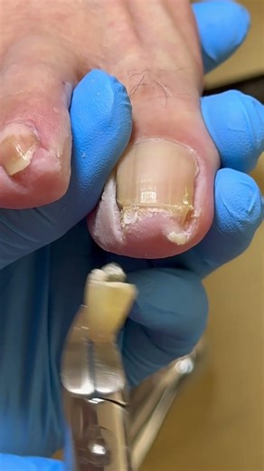 The Long Toenails Are Finally Free! #nails #satisfying