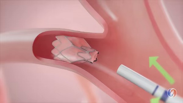1.6K views · 36 reactions | Bronchoscopic lung volume reduction is a leading-edge, minimally invasive treatment option that can help reduce symptoms of severe COPD/emphysema. The procedure utilizes a bronchoscope to place one-way valves in lung airways. The valves stop air from entering the diseased part of the lungs and allow the healthy part of the lungs to expand which enables patients to breathe easier. https://bit.ly/2YyI5CE | El Camino Health | Facebook