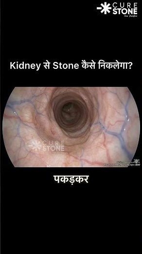 Removing a Kidney Stone with a Basket (Satisfying 3D Animation) | RIRS | Laser Treatment