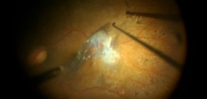 The Importance of Serial OCT Scans in Tractional Retinal Detachment - Eyetube