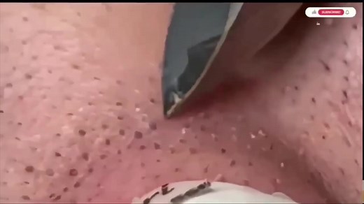 #blackheads #pimples #acne #steatocystema #satisfying #hairs #follicles #nose Hair follicles removal from nose, Extreme blackheads removal from nose, blackheads on nose