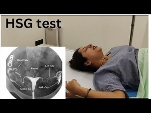 My HSG ( tube test ) experience😓 without anesthesia bht painfull hota h