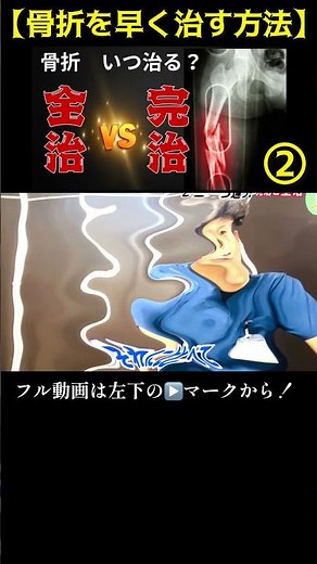 【骨折が治るまで】骨折はいつ治る？全治は治ってない。骨折後の全治と完治は違う！② #リハビリ #手術 ＃骨折