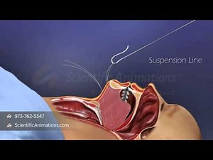 Sleep Apnea Treatment