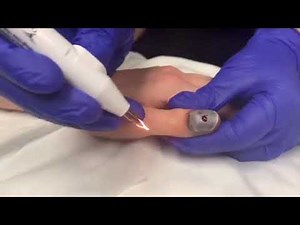 Spurting Blood Drainage From Nail Hematoma