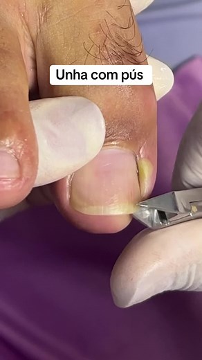 Professional Toe Nail Treatment Process Explained