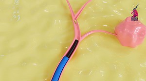 salivary stone endoscopic removal animation.mp4