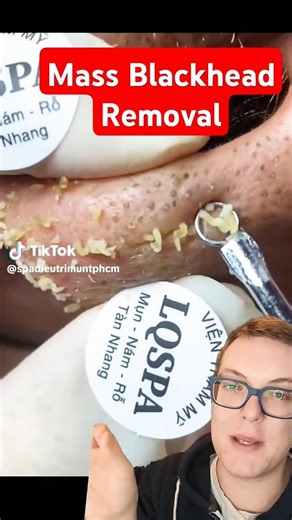 Rapid BLACKHEAD REMOVAL - Speedy Blackhead Plucking #shorts