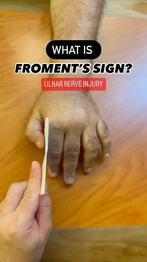 Eli Yovits OTR/L, CHT on Instagram: "💥Froment’s Sign💥 ❓How does a Froment’s sign occur❓ ▪️The Adductor Pollicis (AP) is a strong, triangular shaped muscle that pulls the thumb in toward the hand. It is very important during functional pinch. ▪️The AP is innervated by the ulnar nerve. If there is an injury to the ulnar nerve, the AP may be weakened and/or atrophied. ▪️If the AP is not strong enough to provide lateral pinch, the hand attempts to compensate by activating the Flexor Pollicis Longu
