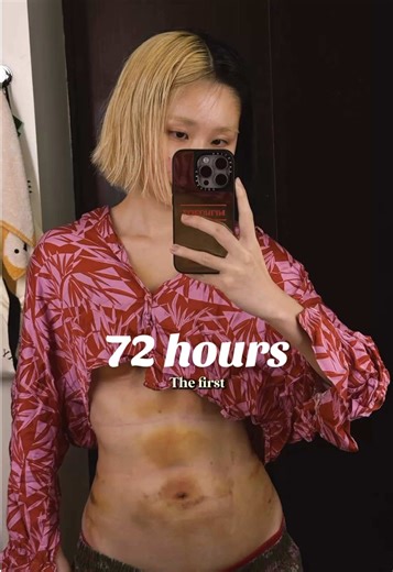 Surgery Diary Ep 6: 72 Hours Post Natural Fat Transfer