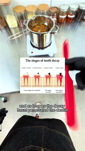 Remineralizing Gum for Early Stage Cavities