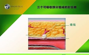 Angio-Seal VIP Video缝合器械