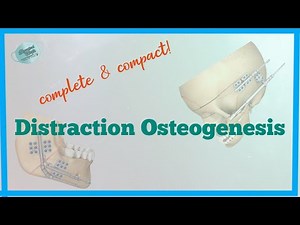 DISTRACTION OSTEOGENESIS