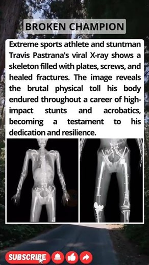 Travis Pastrana's X-Ray Looks Like a Hardware Store! 😱