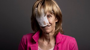 Der Krebs nahm ihr das halbe Gesicht – nun ist sie für den Prix Courage nominiert
