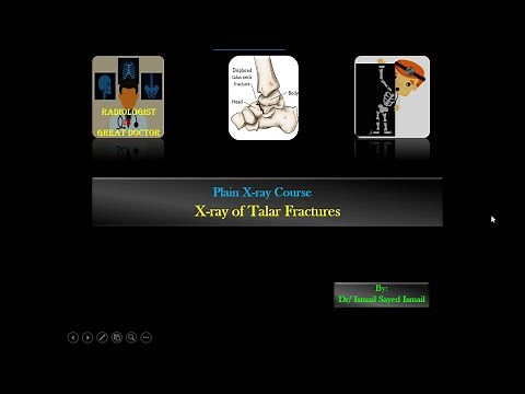 X ray of Talar Fractures For Radiology Residents