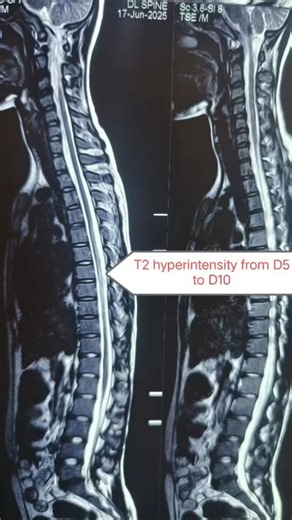 Dr. Naveen Kumar on Instagram: "A 13 year girl presented with spastic ataxic gait x 1 month. On examination -Anemic, spasticity in both lower limbs, Knee jerk- brisk, ankle jerk- absent, romberg sign positive. Investigations- Hb -8, vit B12- 108( deficiency), anti parietal cell antibody- positive MRI thoracolumbar spine with whole spine screening - T2 hyperintensity from D5 to D10, on axialT2- dorsal column hyperintensity. SACD- Subacute combined degeneration of spinal cord. Patient responds wel